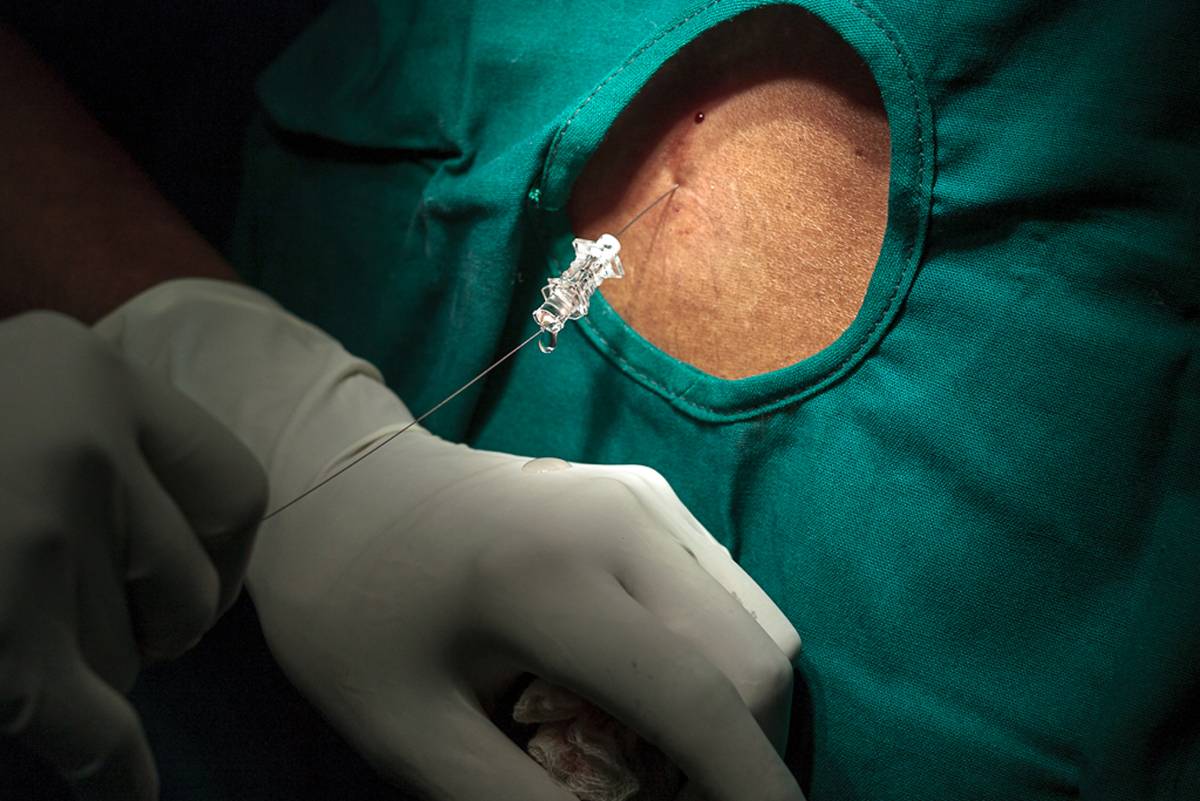 Neuraxial Anesthesia and CSF Dynamics