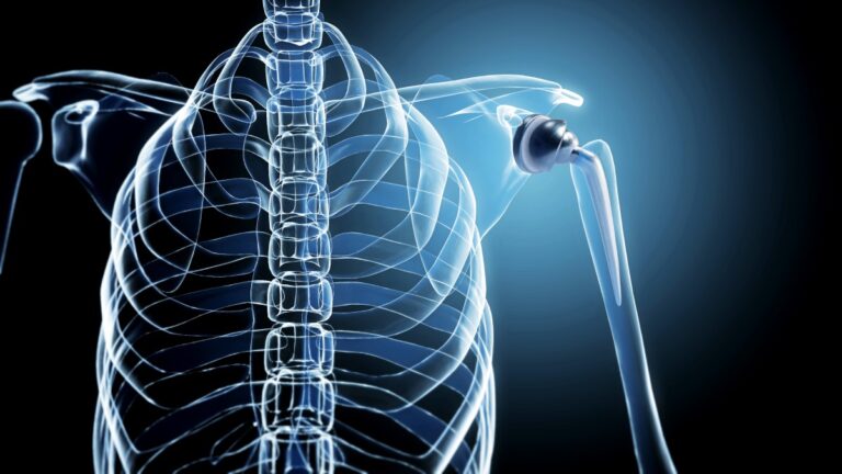 Total Shoulder Arthroplasty